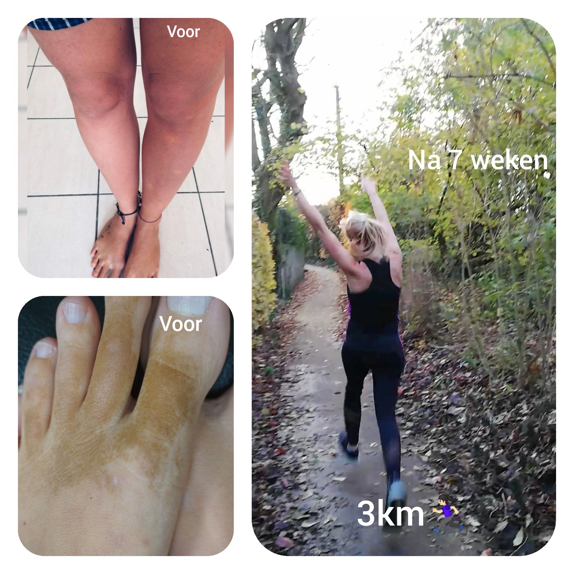 Voor en na foto van de behandeling. De patient is gelukkig en kan terug wandelingen maken.